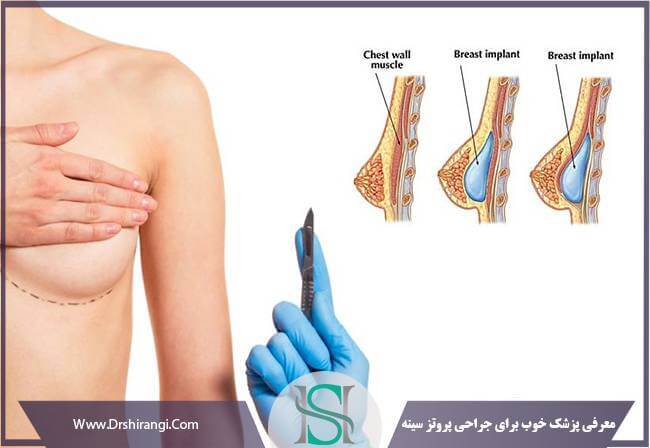 جراح خوب پروتز سینه در ایران