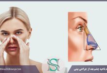 تورم چشم بعد از رینوپلاستی