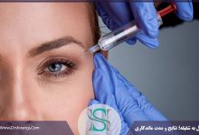 تزریق ژل به شقیقه