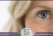موثرترین روش درمان خطوط پنجه کلاغی دور چشم