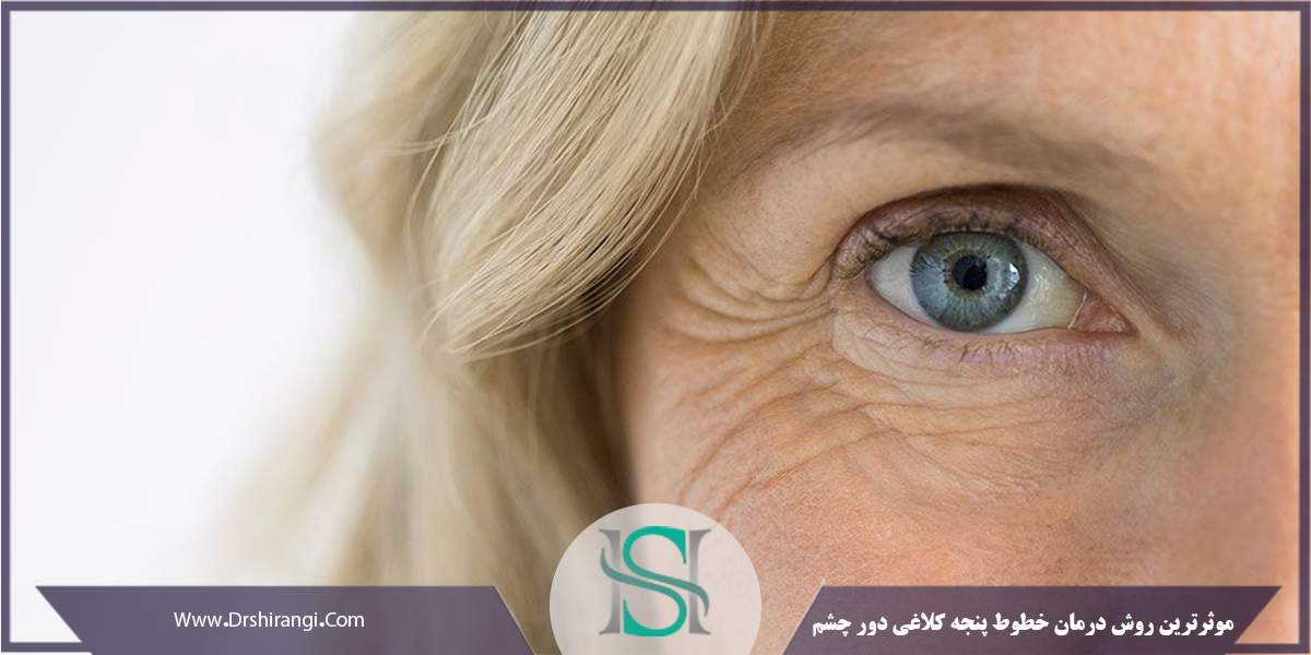 موثرترین روش درمان خطوط پنجه کلاغی دور چشم