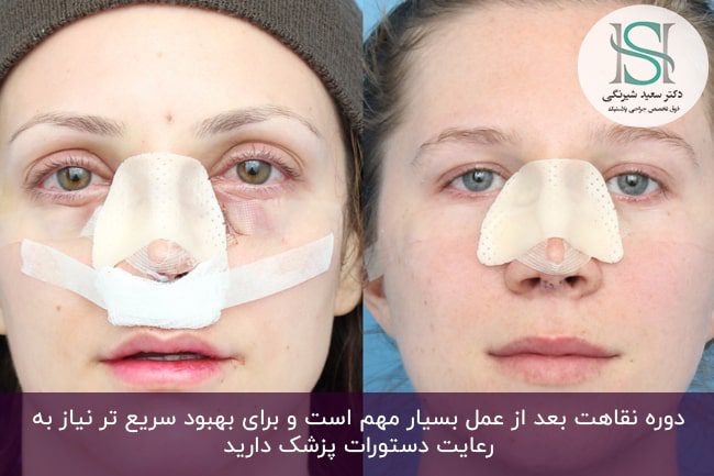 عمل بینی‌ گوشتی فانتزی