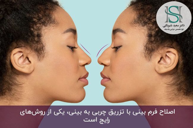 قبل و بعد عمل بینی‌ معمولی