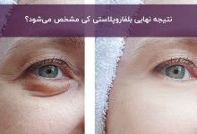 نتیجه نهایی عمل بلفاروپلاستی کی مشخص می‌شود؟