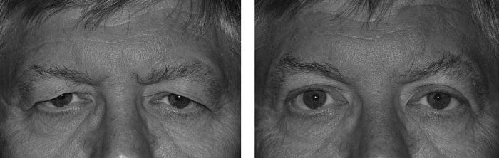 تغییر فرم چشم بعد از بلفاروپلاستی