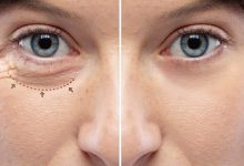 کوچک شدن چشم بعد از بلفاروپلاستی