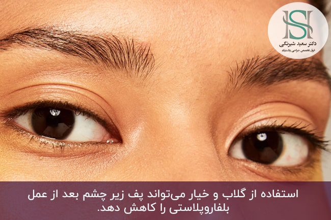 درمان‌های خانگی برای کوچک‌ شدن چشم‌