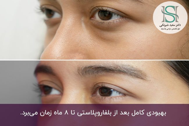 درمان کوچک‌ شدن چشم‌‌ها بعد از بلفاروپلاستی‌