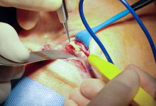 عوارض جراحی پلک بالا