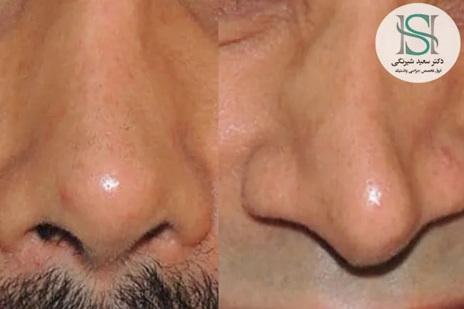 جلوگیری از ‌فرورفتگی‌ ‌بینی‌ ‌بعد از ‌عمل